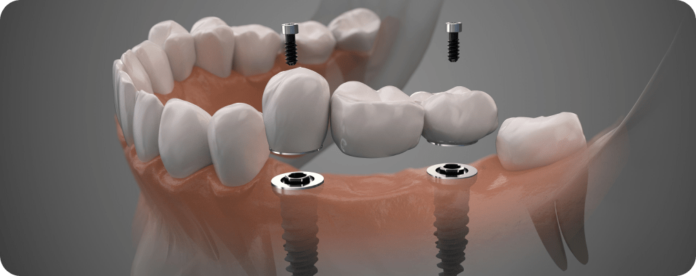 Les Implants dentaires