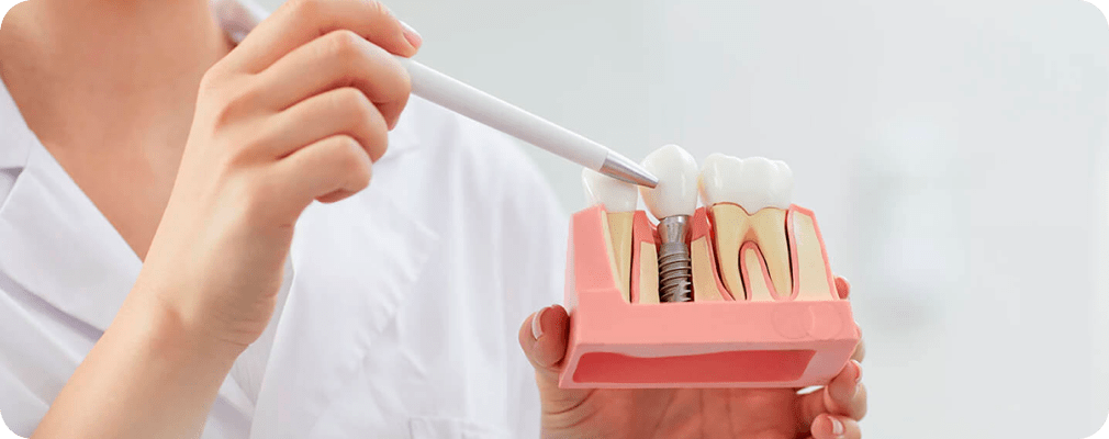De l'implant à la dent