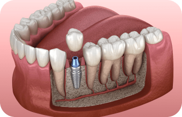 la duréé de vie d'un implant dentaire