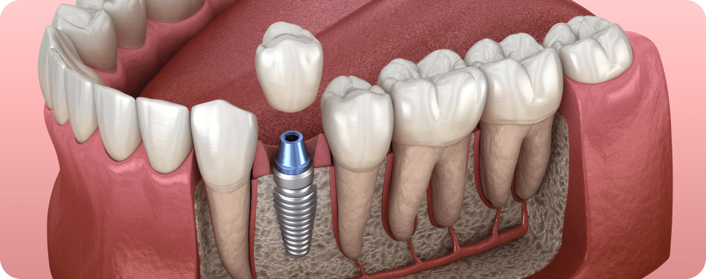 Quelle est la durée de vie d’un implant dentaire ? Le cabinet dentaire Titane vous explique !